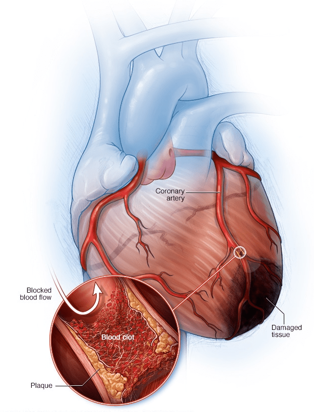 picture of blood clot in heart