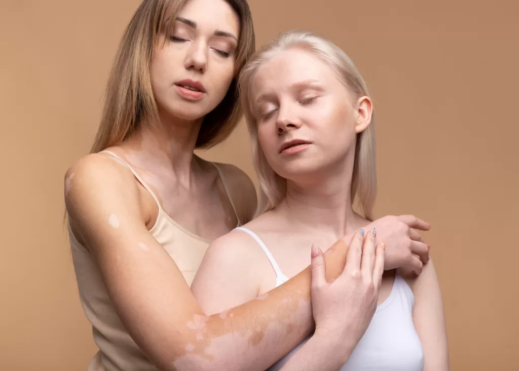 Girls with Vitiligo