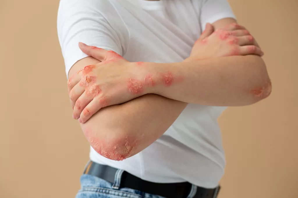 PERSON SUFFERING ECZEMA