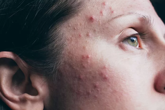 acne vulgaris